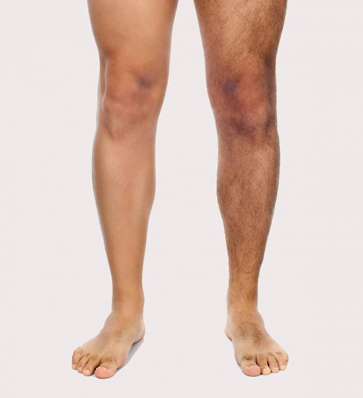 Épilation des jambes par laser Sherbrooke