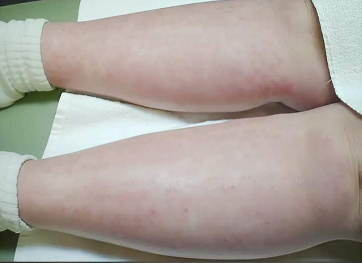 Réaction inflammatoire laser vs psoriasis (durée 1 à 3 jours)