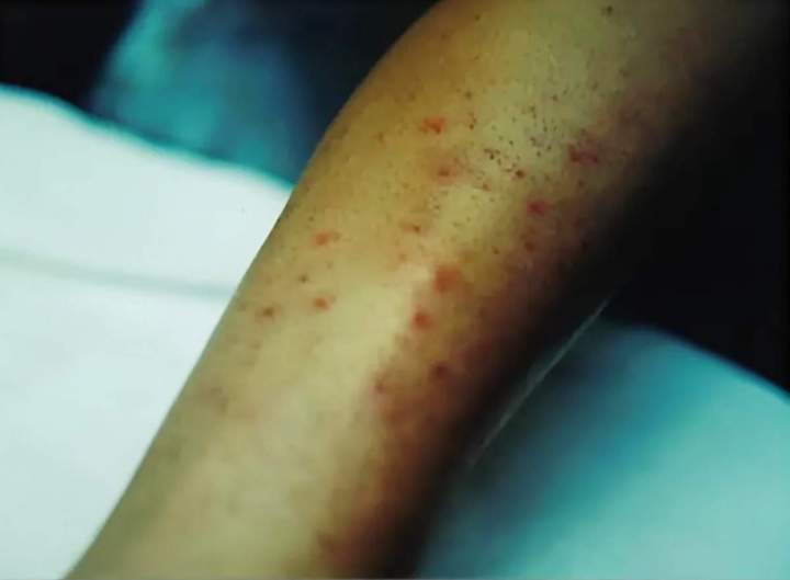 Petites brûlures 24h post-traitement (durée 3 à 4 jours)