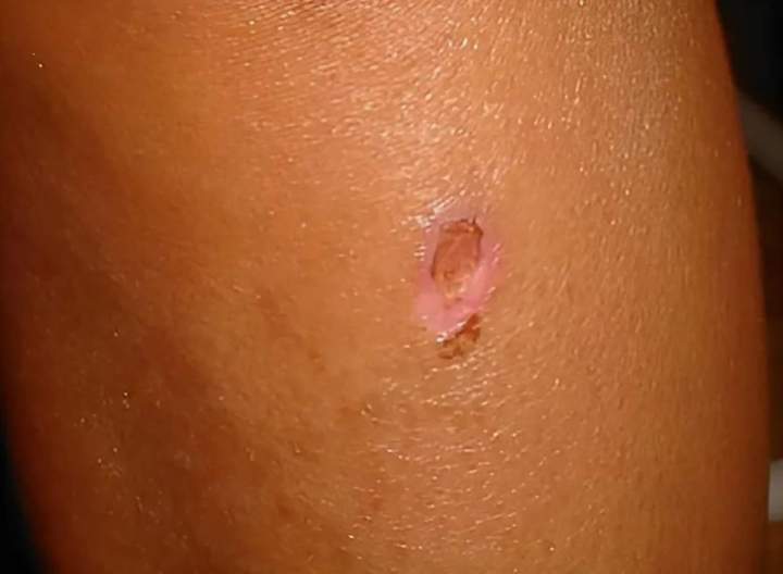 Petite région hypo pigmentée pendant 3 mois