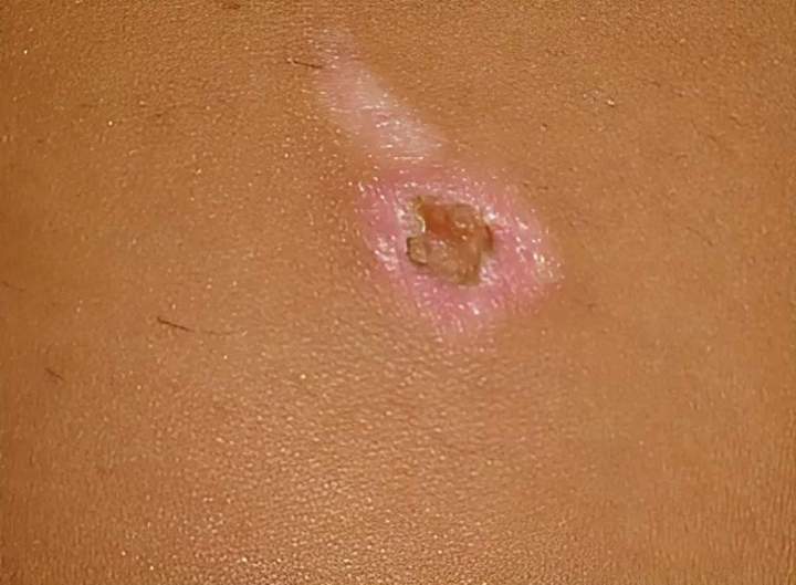 Brûlure durée 1 à 2 semaines