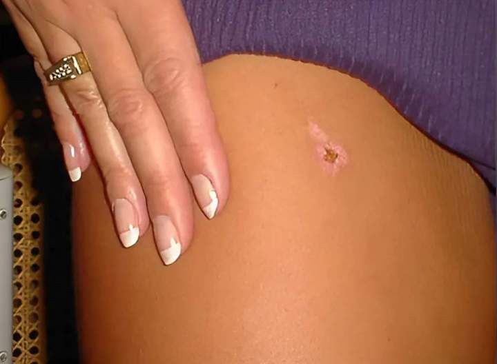 Petite cicatrice résiduelle