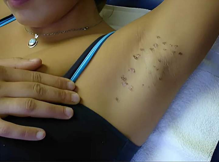 Brûlure aux aisselles (peau bronzée)