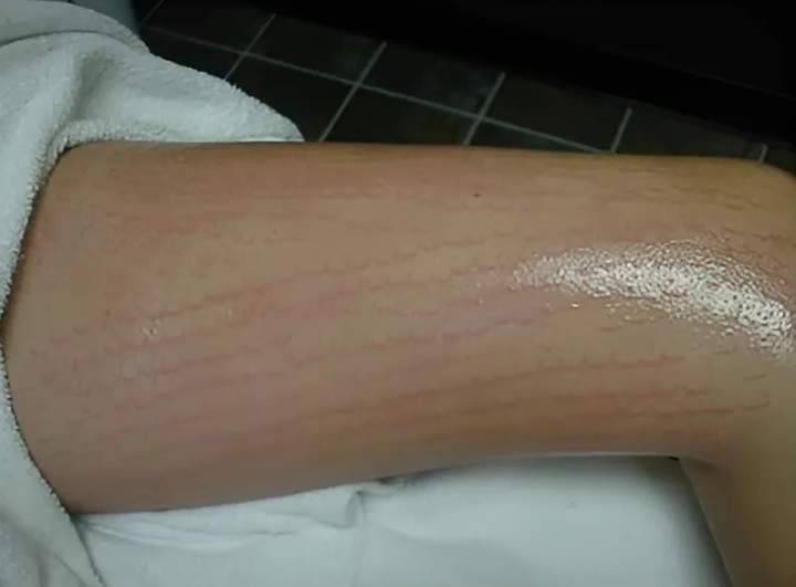 Brûlure superficielle / photosensibilité durant de 3 à 5 jours