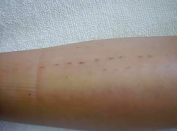 Brûlure sur région plus osseuse / peau bronzée (tibia et cheville) 